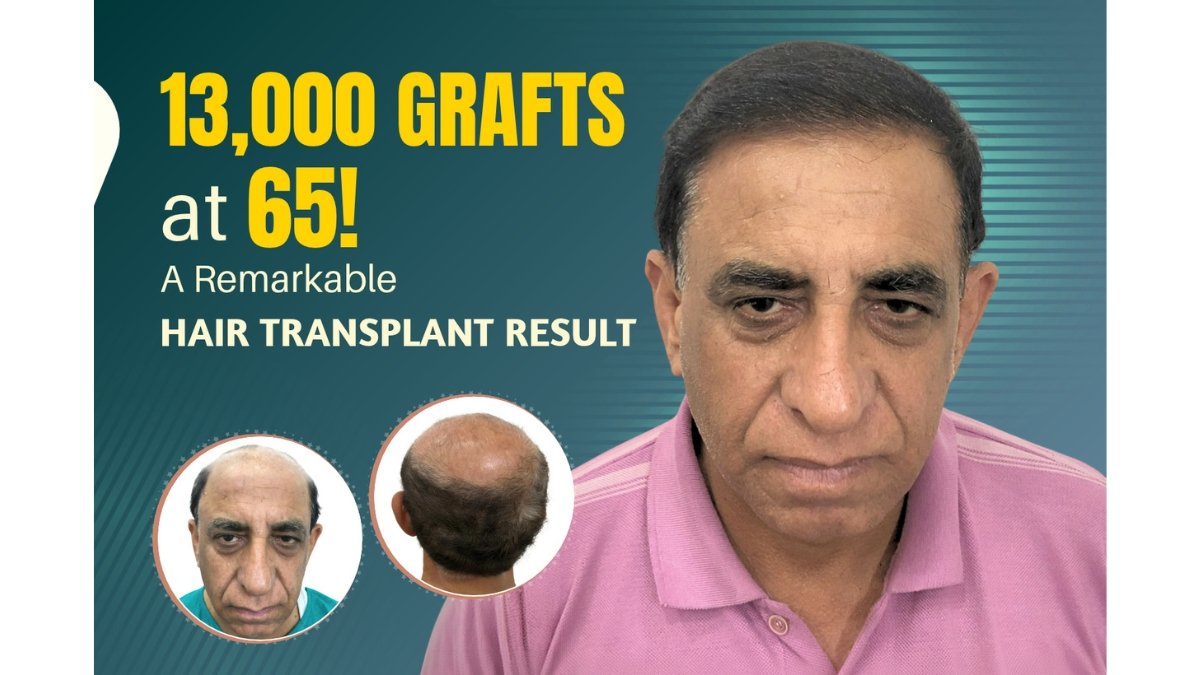 65-Year-Old, 13,000 Grafts Implanted in a Single Session: An Insight into a Remarkable Hair Transplant Procedure